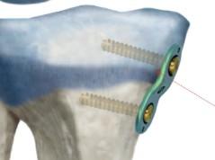 8-подібна терасна пластина, відстань між отворами 16мм, з двома канюльованими гвинтами діаметром 4.5мм ( Double Medical Technology Inc.)